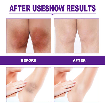 EELHOE Rejuvenator Areola Intimate Area Rejuvenator Lip Joints Melanin Removal